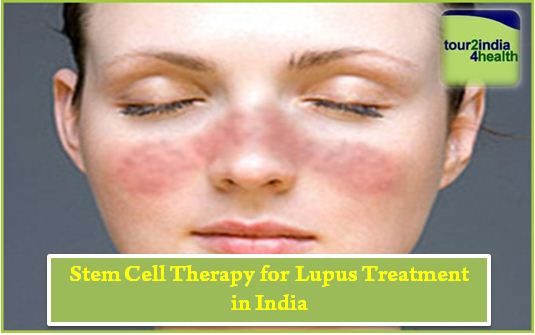 stem cell therapy for lupus treatment in India, Cost of stem cell therapy for lupus treatment in India, Low cost stem cell therapy for lupus treatment in India,